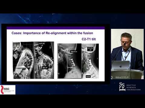 Can We Define Clinically Relevant DJK in Cervical Deformity Surgery - Themistocles Protopsaltis, MD
