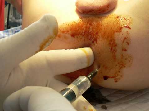 Prostata, wie zu reinigen Wie ein Geheimnis der Prostata machen