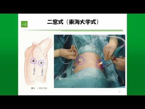 肺がんの手術療法 | 静岡がんセンター