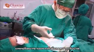 ดูดไขมันเพื่อลดขนาดเต้านมชาย