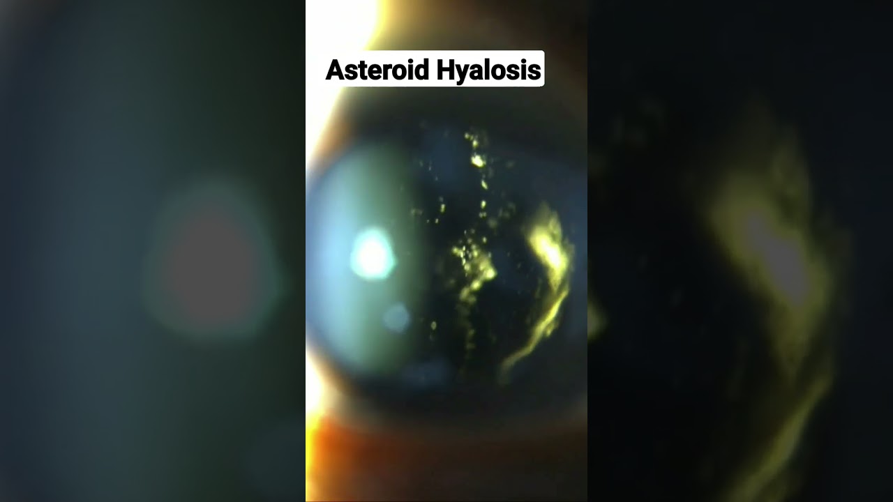 Asteroid Hyalosis