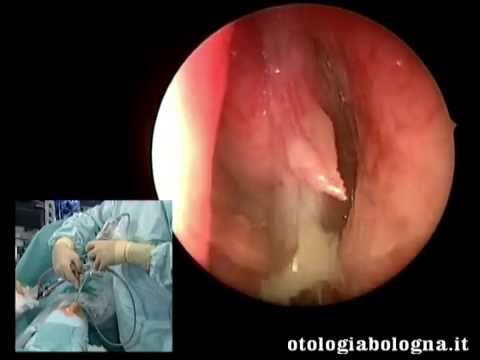 Parassiti di capelli alla persona sulla testa di fotografia Che tolgono helminths