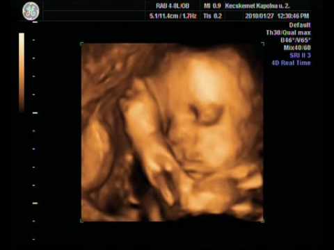 Kinga 4D-s ultrahangja