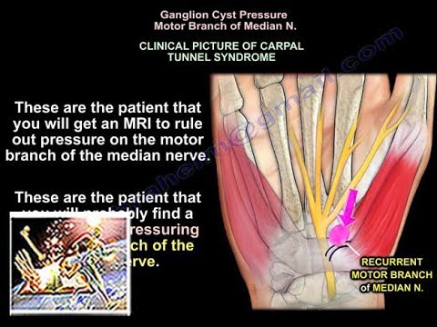 carpal ganglion kezelés