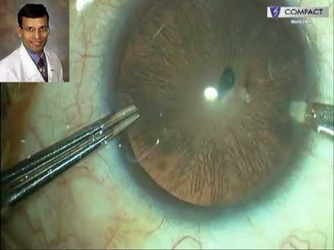 Management of Intralenticular Foreign Bodies
