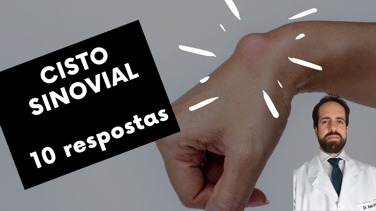 Cisto Sinovial - 10 Perguntas mais frequentes