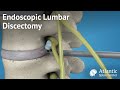 Endoscopic Lumbar Discectomy