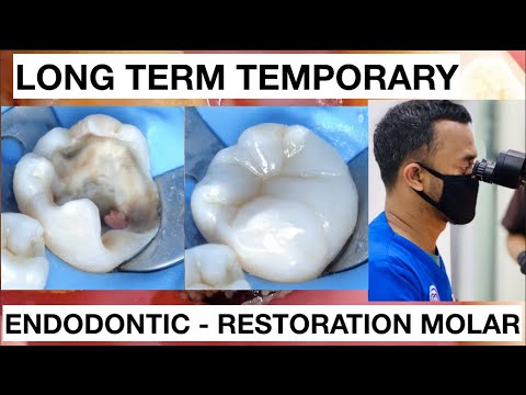 Dental Endodontic Direct Restoration Long Term Temporary Composite