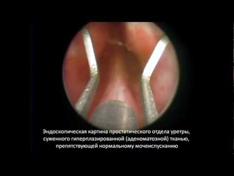 Какие препараты используют для лечения простатита