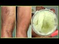 YOU WILL NOT BELIEVE WHAT I USE TO GET RID OF MY VARICOSE + SPIDER VEINS |Khichi Beauty