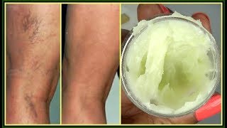 YOU WILL NOT BELIEVE WHAT I USE TO GET RID OF MY VARICOSE + SPIDER VEINS |Khichi Beauty