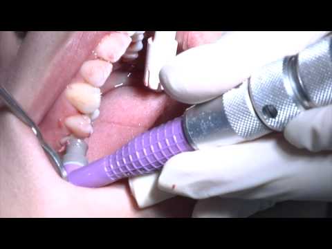 YouTube video about: Which describes the typical procedure during a dental cleaning?