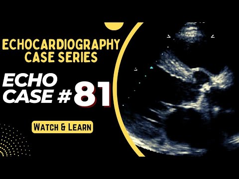 ECHO CASE 81 | Echocardiography Spot Diagnosis Series | Echocardiogram Interpretation made easy