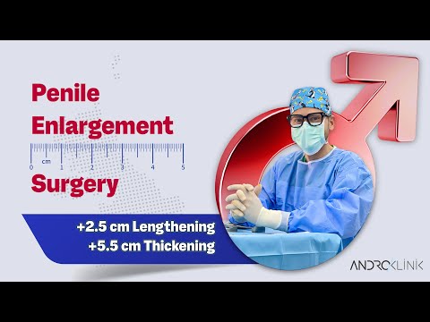 Penile Enlargement Surgery (+2.5 cm lengthening, +5.5 cm thickening)