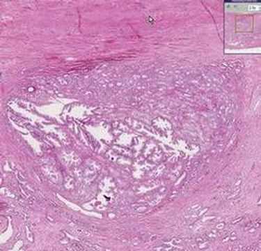 Pleomorphic adenoma skin pathology outlines