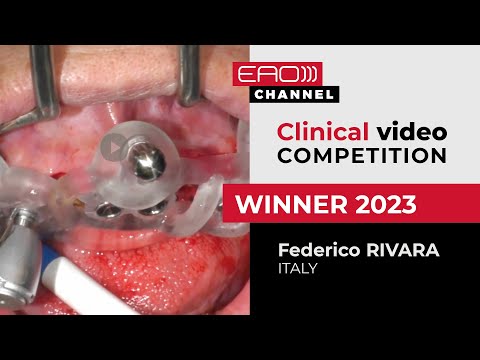 Upper jaw full-arch post-ex immediate loading rehabilitation and gummy smile treatment
