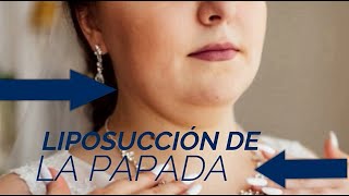 ¿Qué es la liposucción de la papada - Dr. Jorge Espinosa