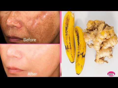 Banana & Ginger Get Rid of Hyper pigmentation &...