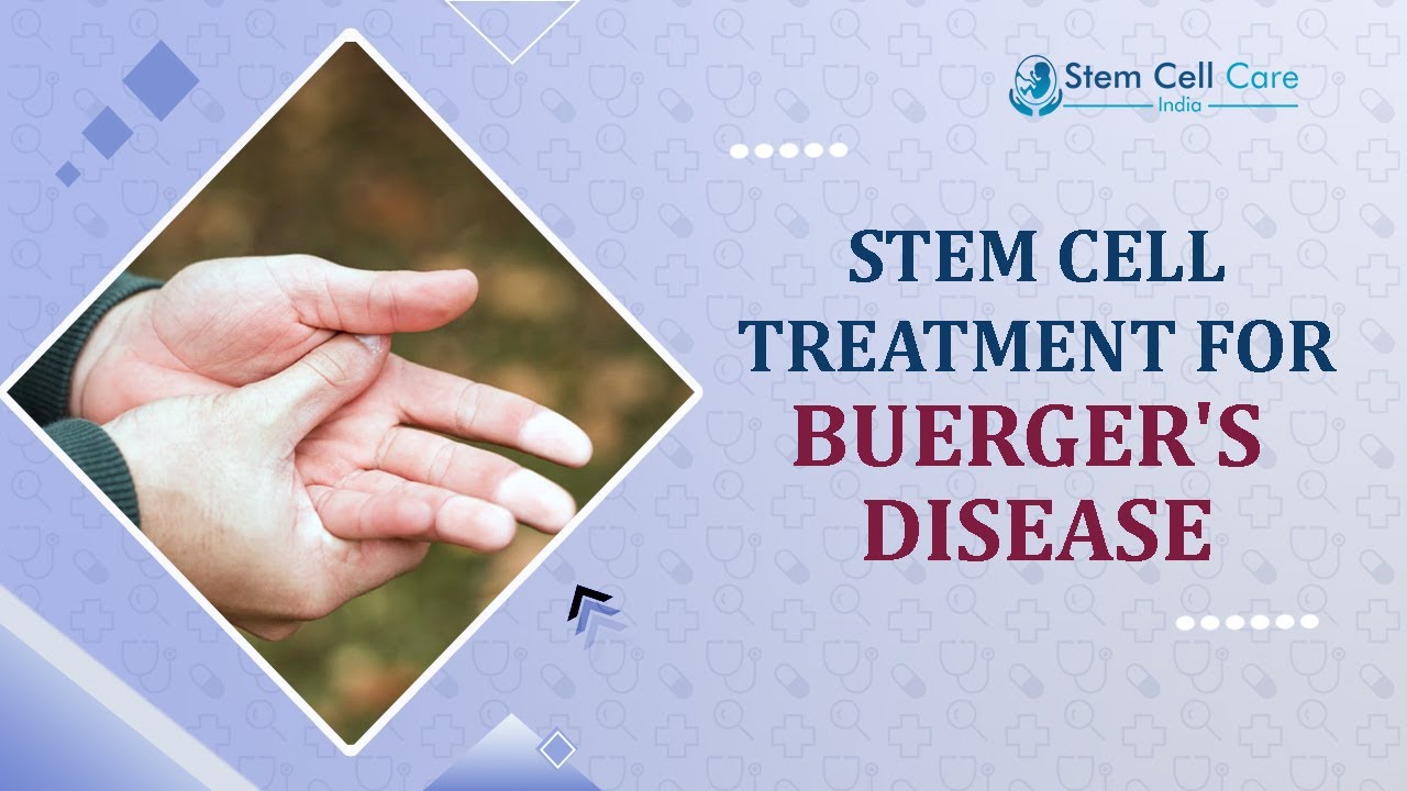 Stem cell Hospital For Buerger's Disease | Best Treatment For Buerger's Disease In Delhi