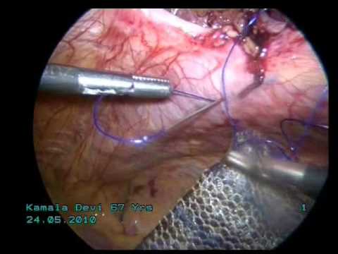 laparoscopic repair of a big incisional hernia