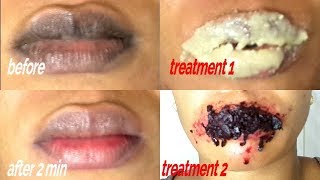 EASY 2 MINUTES STEPS REMOVE DARK LIPS GET SOFT PINK LIPS FAST