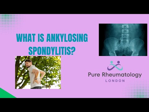Ankylosing Spondylitis Explained | Chronic Back Pain & Morning Stiffness | Pure Rheumatology London