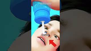 Sinus Rinse Procedure (3D Animation)