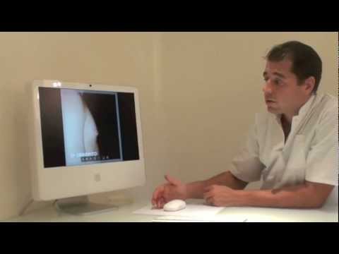 comment guerir ptosis