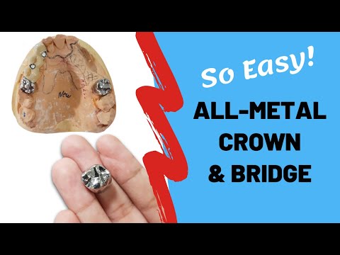 All-Metal Crowns | Advantages | Disadvantages | Indications