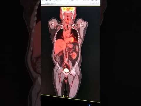 Whole Body PET Scan (positron emission tomography)