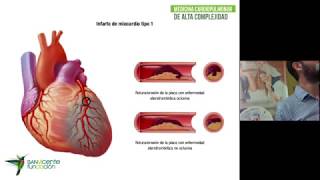 Sábados del Hospital: Síndrome Coronario Agudo y su manejo