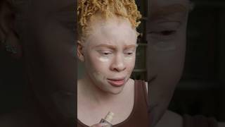 Download lagu YES THESE ARE QUESTIONS #albinismawareness #albinism mp3