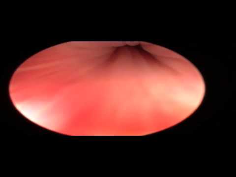 Wie das Prostata Geheimnis passieren Und bestehend aus Spermatozoen Prostatasekreten