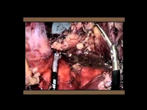 Pancreatectomía y esplenectomía distal laparoendoscópica de un solo sitio