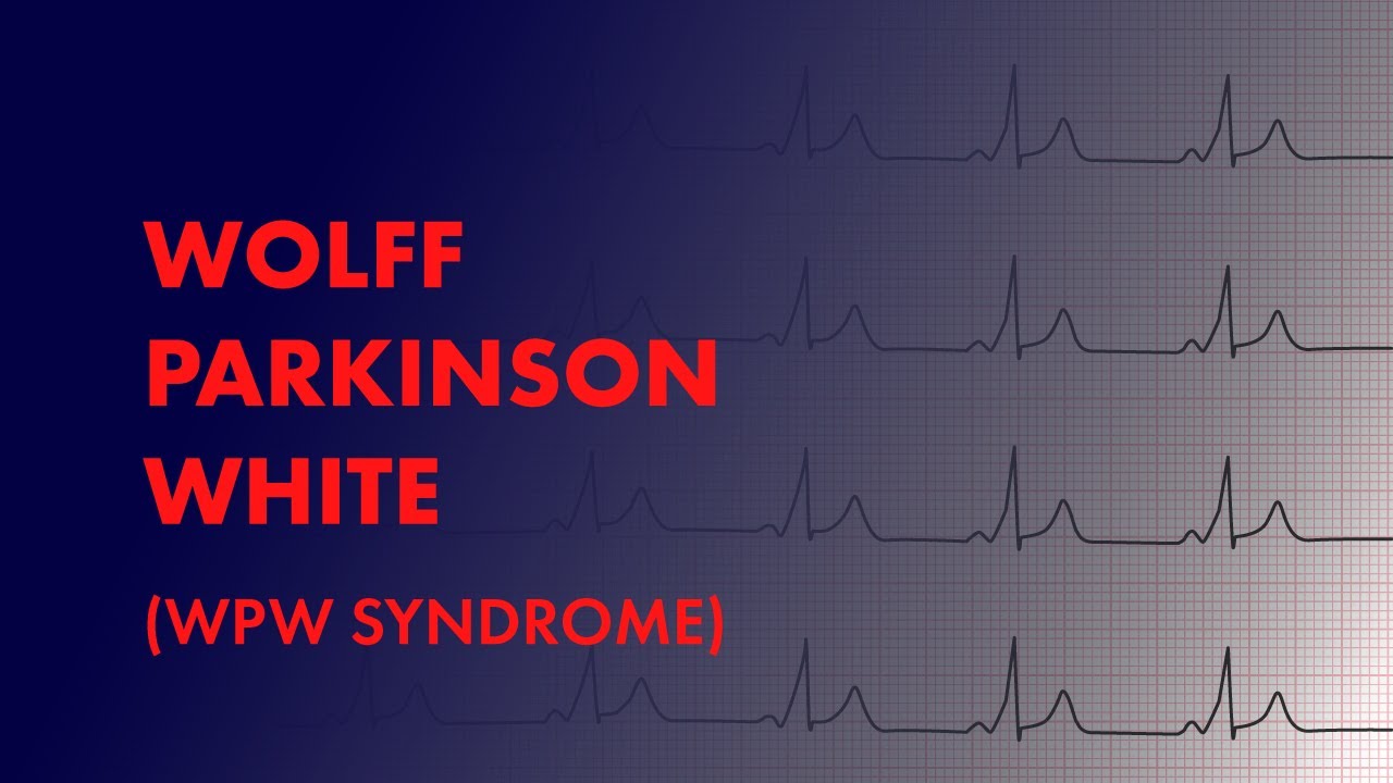 Wolff Parkinson White (WPW Syndrome) -  EKG (ECG) Interpretation