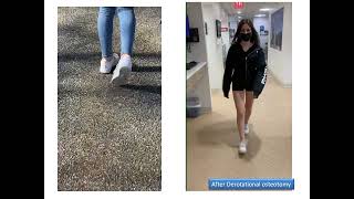 Dr. Rozbruch discusses treatment of excessive femoral anteversion or in-toeing gait