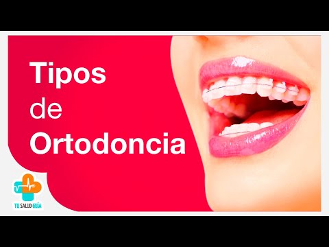 Tipos de Ortodoncia | Tu Salud Guía