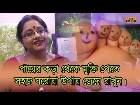 যন্ত্রণাদায়ক পায়ের কড়া থেকে মুক্তি পেতে সহজ ঘরোয়া উপায় জেনে রাখুন। | EP 672