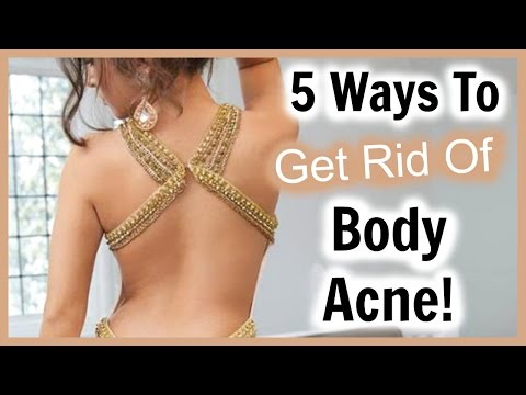 5 Ways to Get Rid of Back Acne! │ How to Get RID of Body Acne and Get Clear Skin Video