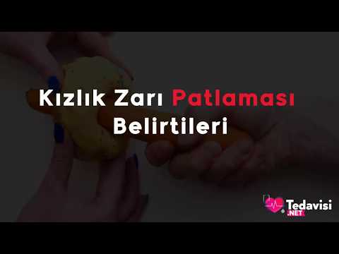 download lagu mp3 mp4 Kzlk Zar Bozulmas Belirtileri, download lagu Kzlk Zar Bozulmas Belirtileri gratis, unduh video klip Kzlk Zar Bozulmas Belirtileri