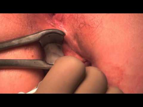 comment soulager avf