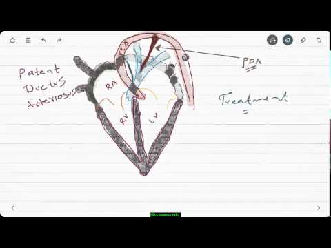 Patent Ductus Areteriosus ( PDA) Tutorial