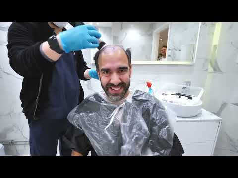 Andreas hårtransplantation (3500 hårsäckar)