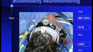 Dr Peter McCall: Anaesthesia, cerebral protection & blood conservation during major aortic surgery