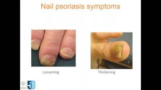 Nail Psoriasis Patient - Educational Webinar