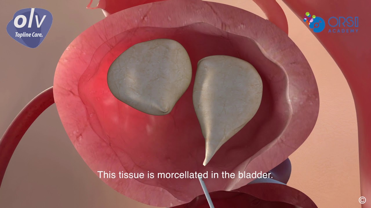 Holep patient animation - OLV Aalst (BE)