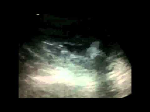 Aneurysm of Superior Mesenteric Artery