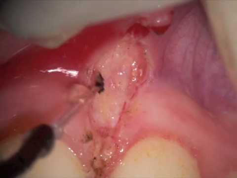 Frenectomy with Picasso Dental Laser