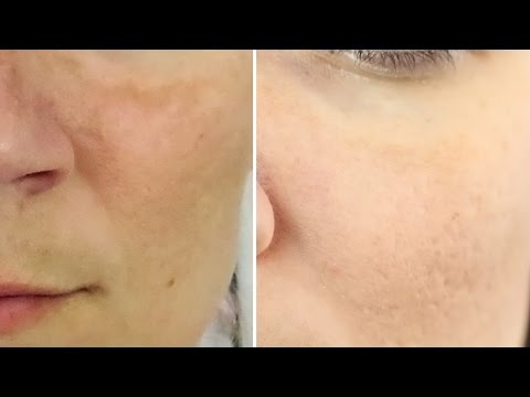 8 Natural Home Remedies to Clear Melasma