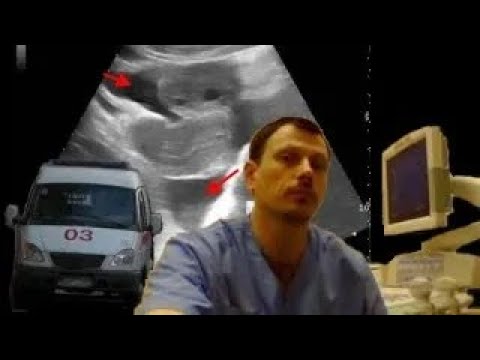 Pediatric Female pelvic ultrasound - Ovarian apoplexy in a girl clinically mimicking appendicitis